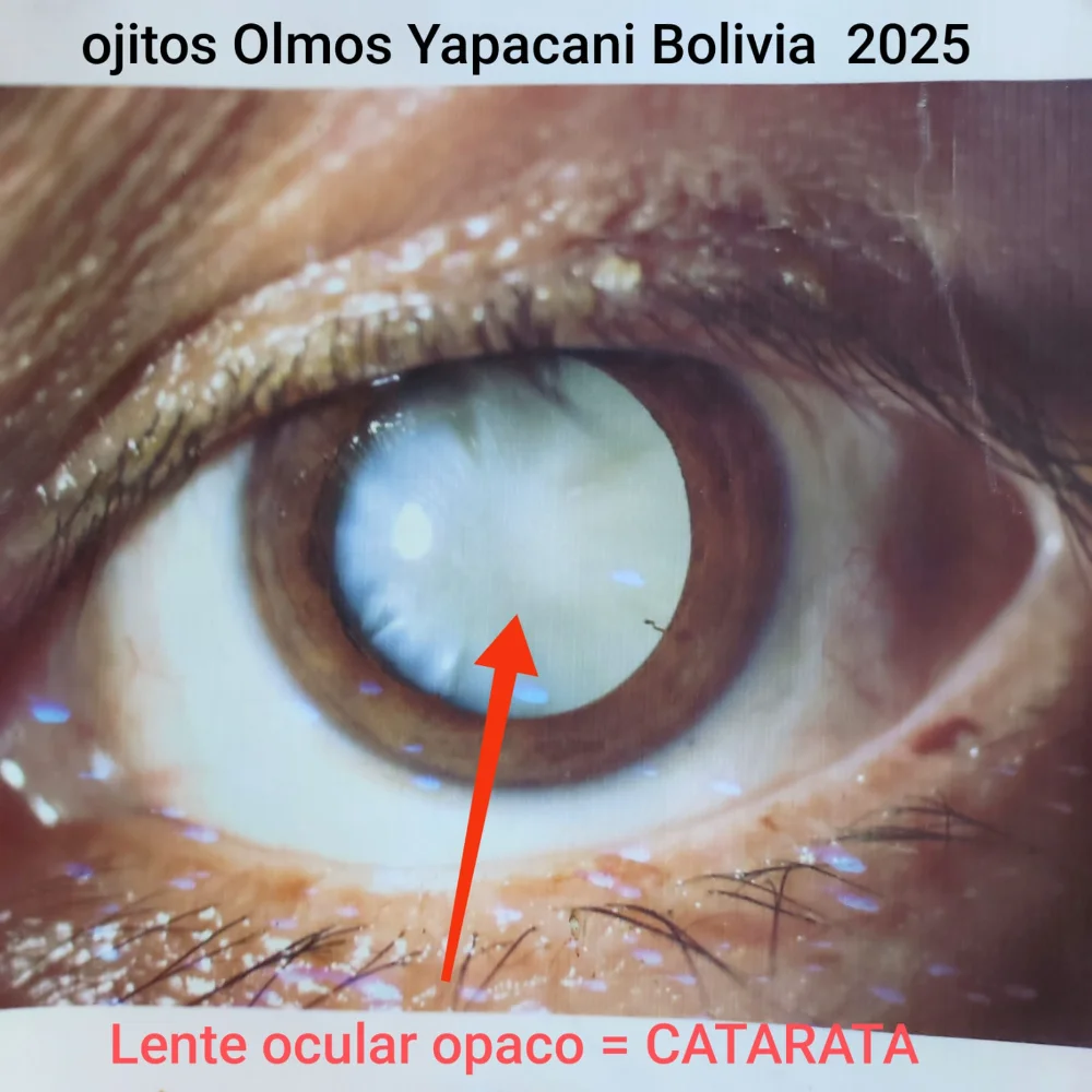 La batalla contra la ceguera: cataratas y hongos oculares, las amenazas más comunes en Bolivia